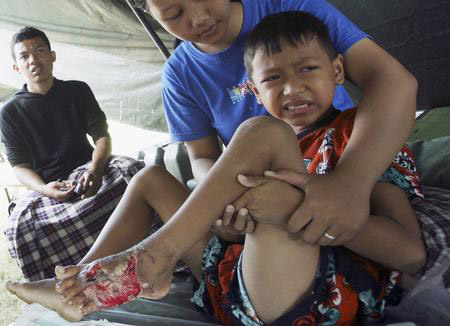 圖文：倖存兒童在治療腳傷